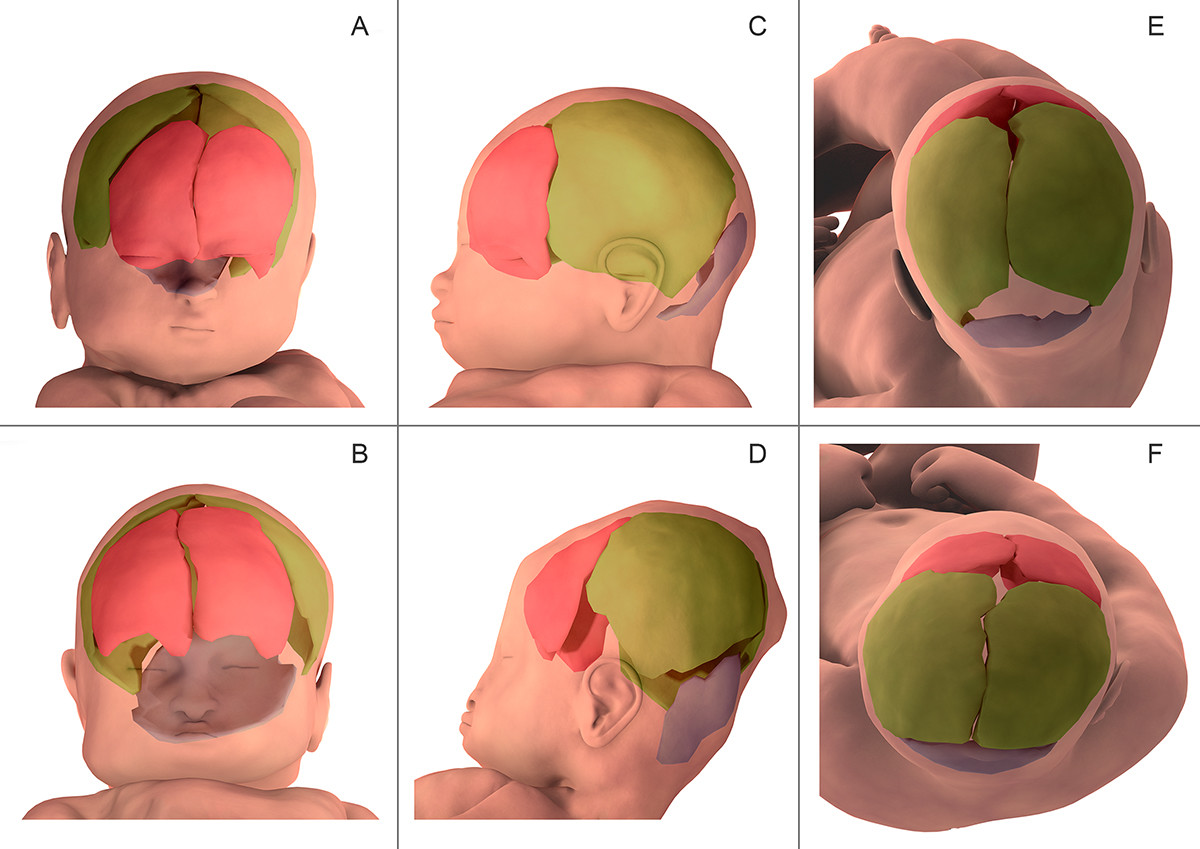 Así se deforma la cabeza del bebé durante el parto para facilitar su paso por la pelvis materna